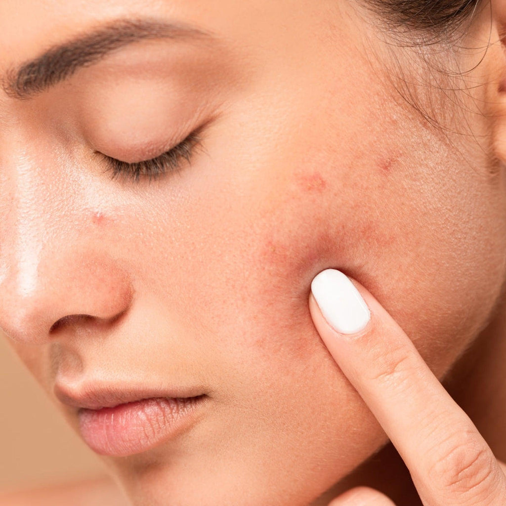 Best Natural Acne Treatments-The Detox Market - Canada