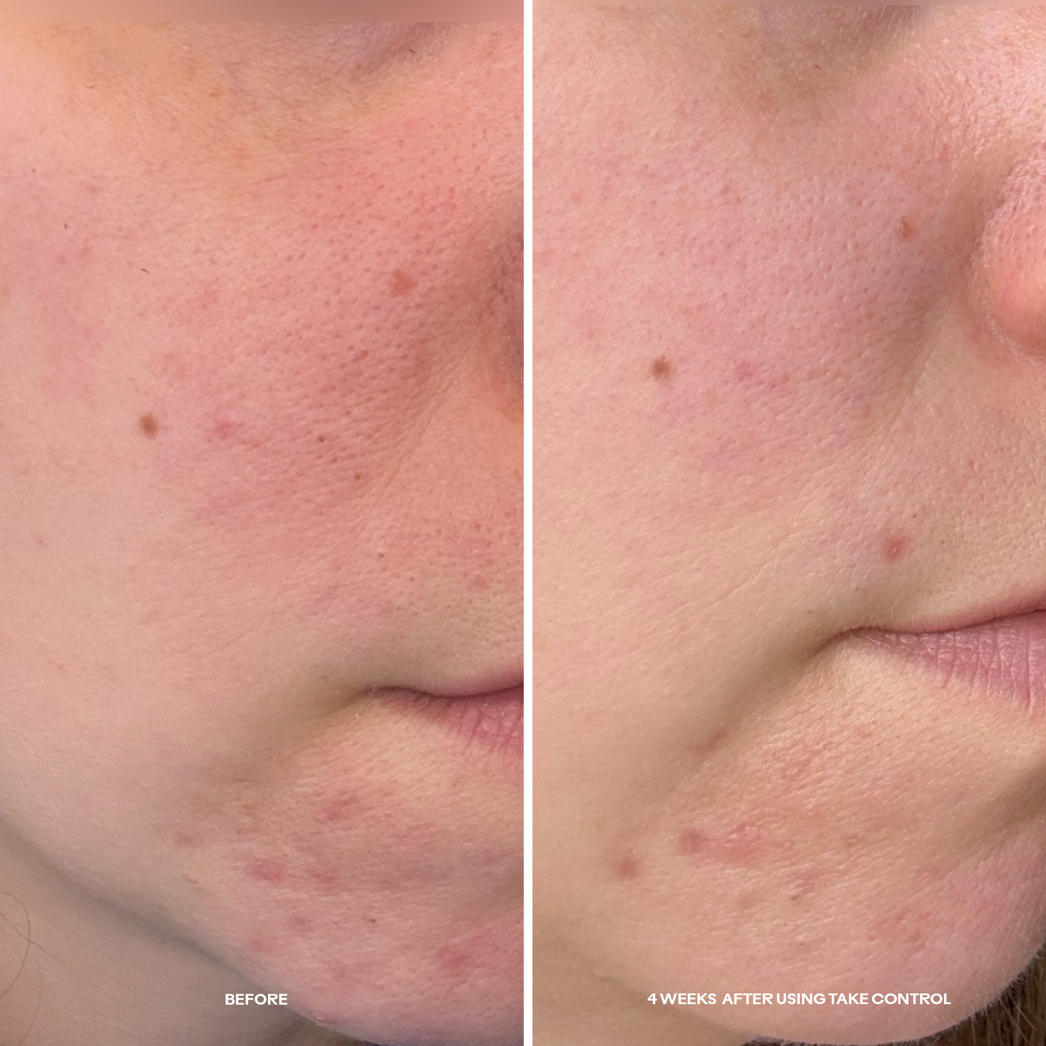 Three Ships-Take Control™ Salicylic + 10% Azelaic Acid Clarifying Serum-Skincare-990478500327_TakeControl_Salicylic_10_AzelaicAcidClarifyingSerum__5_BeforeAfter-The Detox Market | 