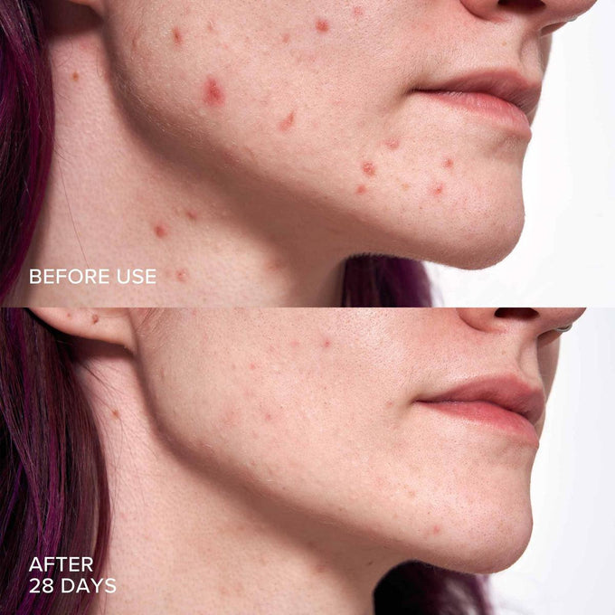 Alpyn Beauty-Pore Perfecting Liquid with 2% BHA + Borage-